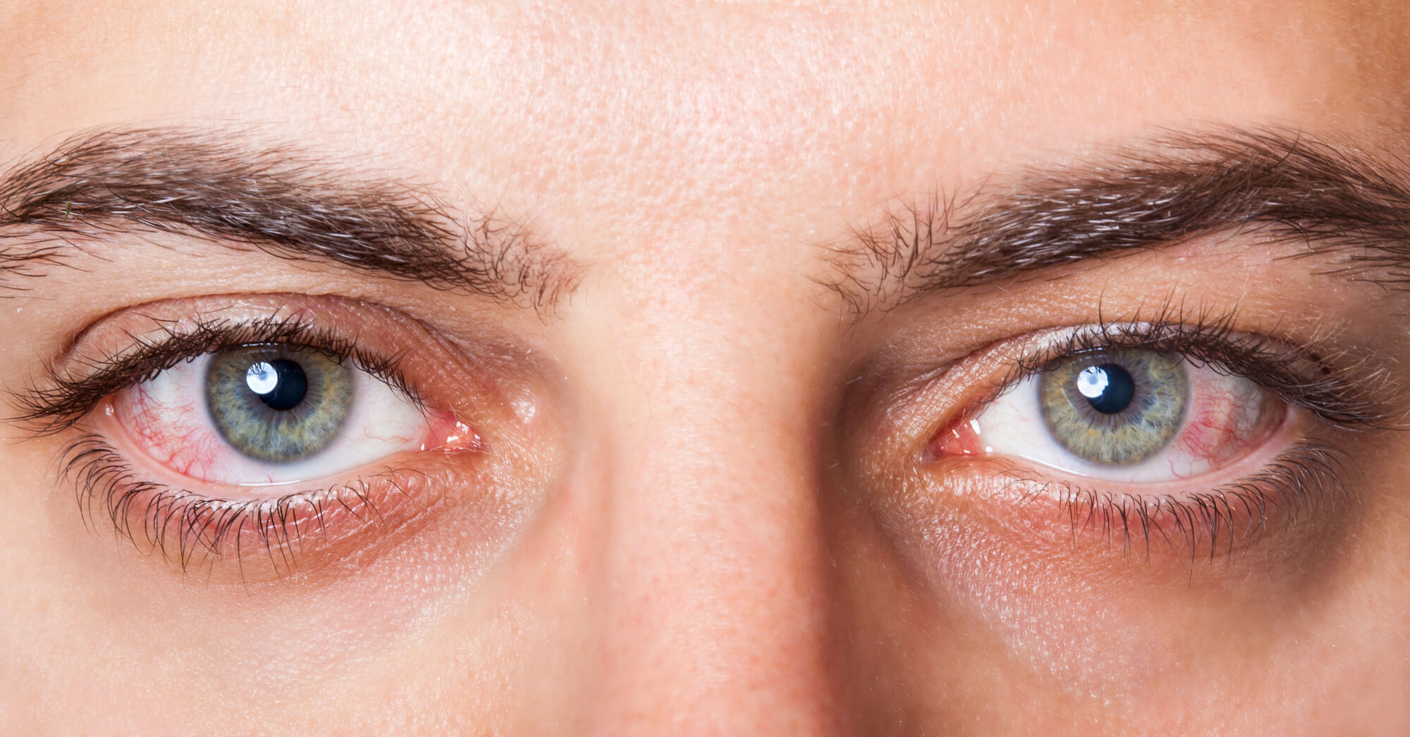 اسباب احمرار العين عدة وأبرزها الحساسية أو التعرض لغبار